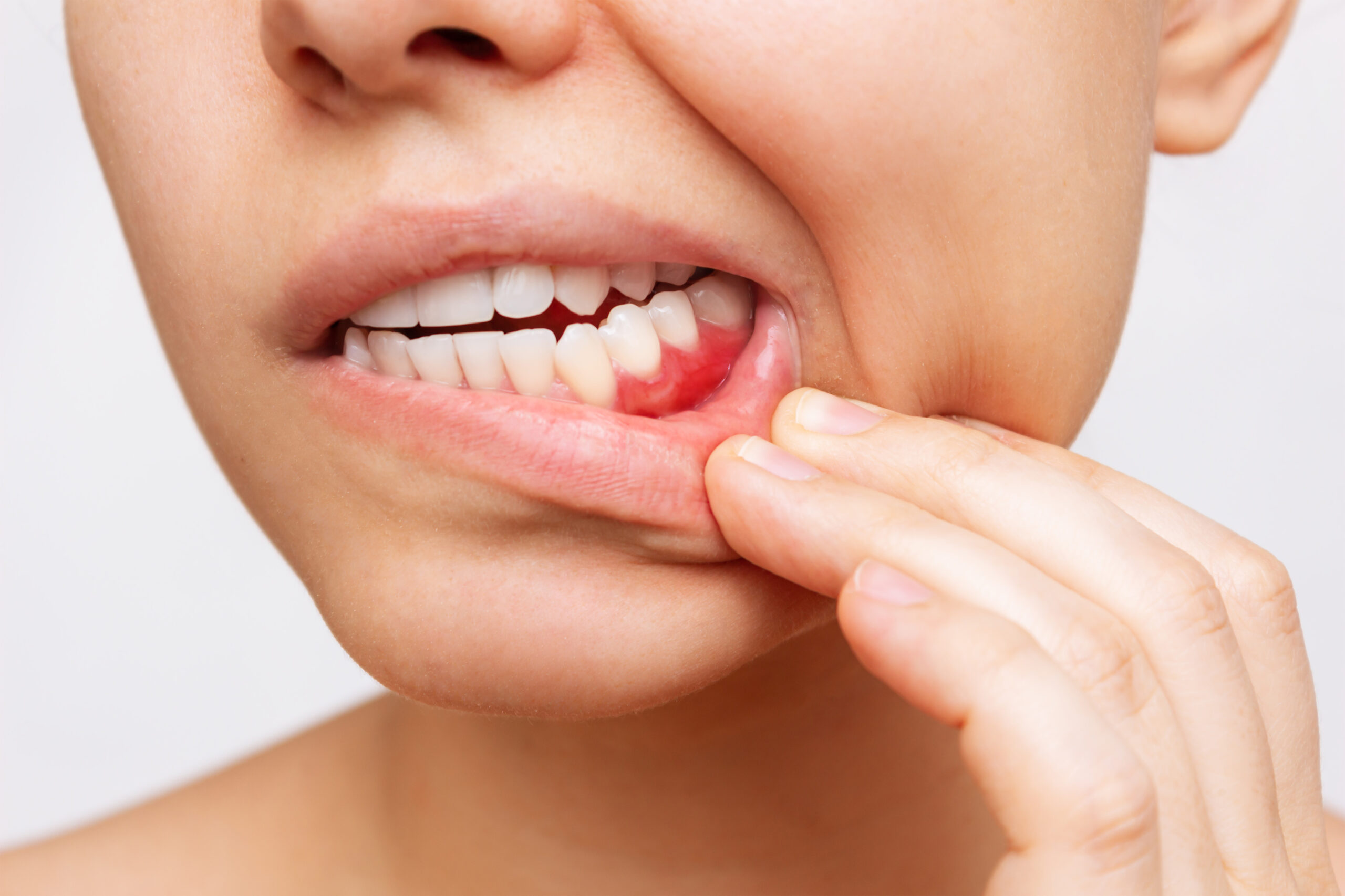 Gum Health